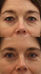 Blefaroplastia completa + resurfacing periocular