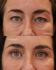 Blefaroplastia completa + resurfacing periocular