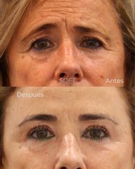 Resultado de nuestra paciente tras blefaroplastia superior + cejaplastia directa + resurfacing