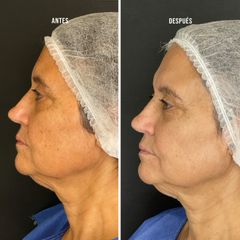 Rejuvenecimiento facial - Clínica Tufet