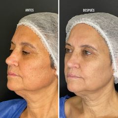 Rejuvenecimiento Facial - Clínica Tufet