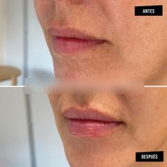 Aumento de labios - Clínica Tufet