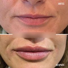 Aumento de labios - Clínica Tufet
