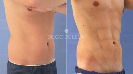 Lipovaser - Clínicas Diego De León