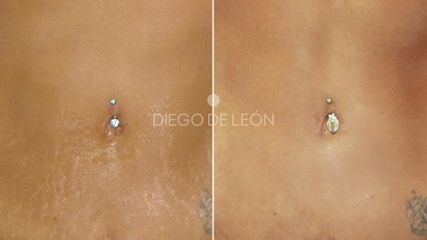 Eliminación de estrías - Clínicas Diego De León