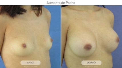 Aumento de pecho - Clínicas Diego De León
