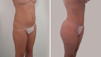Clínicas Diego De León - Lipo Vaser