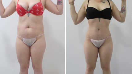 Abdominoplastia - Clínicas Diego De León
