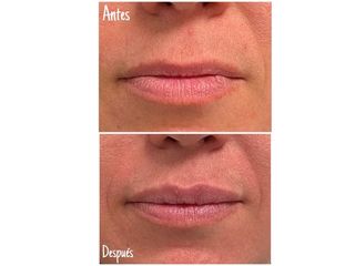 Antes y después Aumento de labios