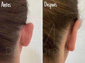 Antes y después Otoplastia 