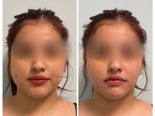 Antes y después Bichectomía