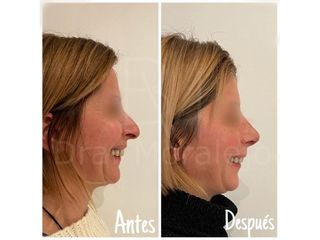 Antes y después Rinoplastia