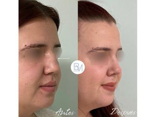 Antes y después Rinoplastia - Dra. Beatriz Moralejo