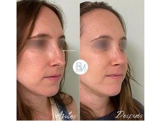 Antes y después Rinoplastia - Dra. Beatriz Moralejo