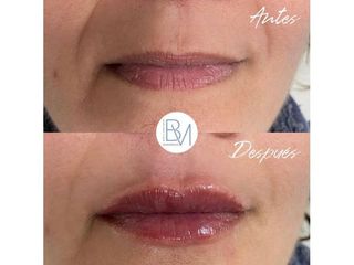 Antes y después Aumento de labios - Dra. Beatriz Moralejo