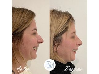 Antes y después Rinoplastia - Dra. Beatriz Moralejo