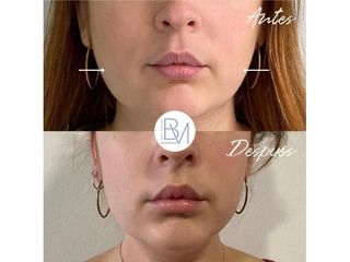 Antes y después Aumento de labios - Dra. Beatriz Moralejo