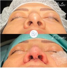 Antes y después Rinoplastia ultrasonica- Dra. Beatriz Moralejo