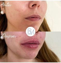 Antes y después Labios con hialurónico - Dra. Beatriz Moralejo