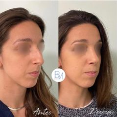 Antes y después Rinoplastia ultrasonica - Dra. Beatriz Moralejo