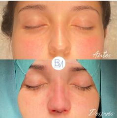 Antes y después Rinoplastia ultrasonica - Dra. Beatriz Moralejo