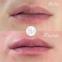 Antes y después Aumento de labios - Dra. Beatriz Moralejo