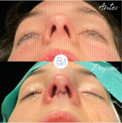 Antes y después Rinoplastia - Dra. Beatriz Moralejo