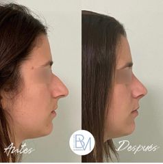 Antes y después Rinoplastia 