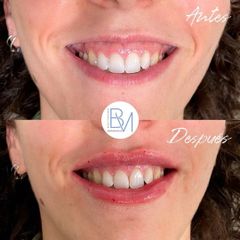 Antes y después Sonrisa Gingival con Ácido Hialurónico - Dra. Beatriz Moralejo