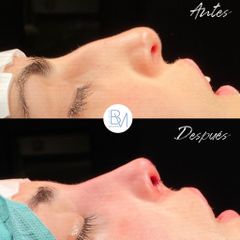 Antes y después Rinoplastia Ultrasónica - Dra. Beatriz Moralejo