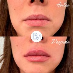 Antes y después Aumento de Labios - Dra. Beatriz Moralejo