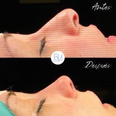 Antes y después Rinoplastia Ultrasónica - Dra. Beatriz Moralejo