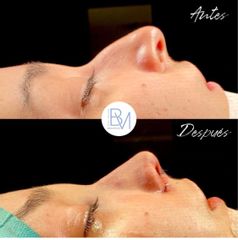 Rinoplastia - Dra. Beatriz Moralejo