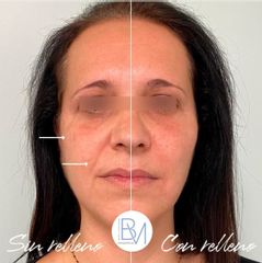 Rellenos faciales - Dra. Beatriz Moralejo