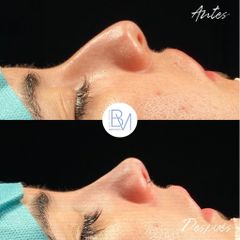 Rinoplastia - Dra. Beatriz Moralejo