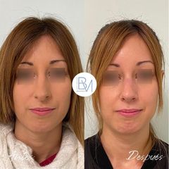 Rinoplastia - Dra. Beatriz Moralejo