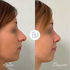 Rinoplastia - Dra. Beatriz Moralejo