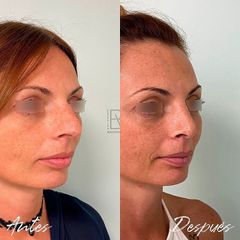 Rinoplastia - Dra. Beatriz Moralejo