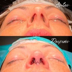 Rinoplastia - Dra. Beatriz Moralejo