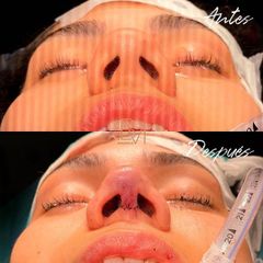 Rinoplastia - Dra. Beatriz Moralejo