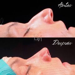 Rinoplastia - Dra. Beatriz Moralejo