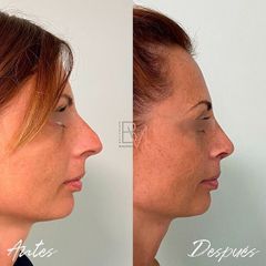 Rinoplastia - Dra. Beatriz Moralejo