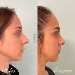 Rinoplastia - Dra. Beatriz Moralejo