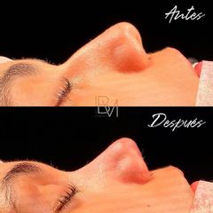 Rinoplastia - Dra. Beatriz Moralejo