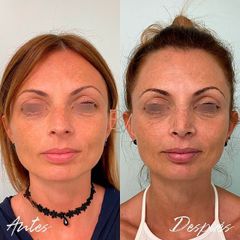 Rinoplastia - Dra. Beatriz Moralejo