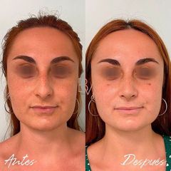 Rinoplastia - Dra. Beatriz Moralejo