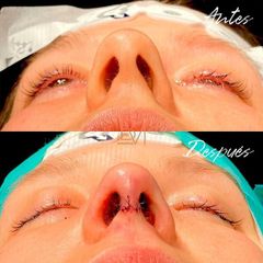 Rinoplastia - Dra. Beatriz Moralejo