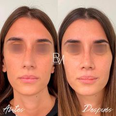 Rinoplastia - Dra. Beatriz Moralejo