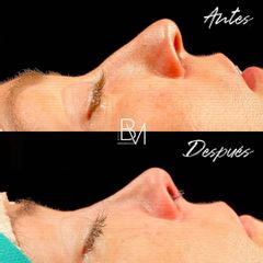 Rinoplastia - Dra. Beatriz Moralejo