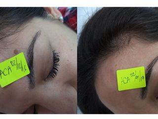 Antes y después tratamiento verrugas